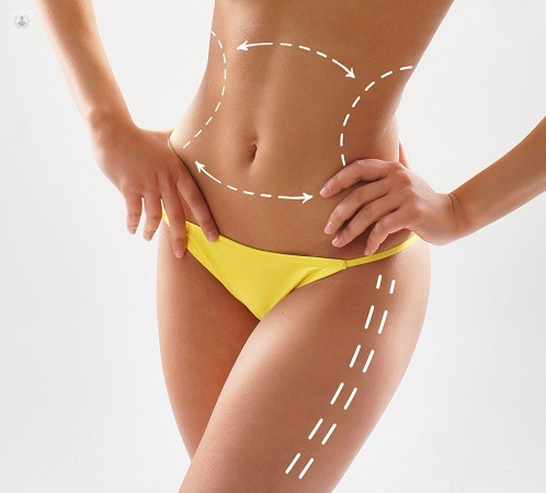 Lipoescultura sin bisturí 